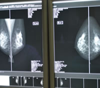 マンモグラフィ（乳房X線2方向撮影）